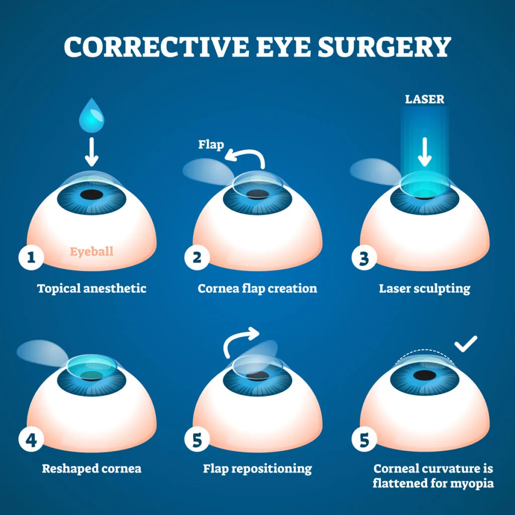 Επέμβαση Femto LASIK